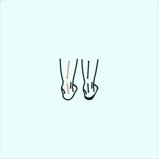 Overpronation